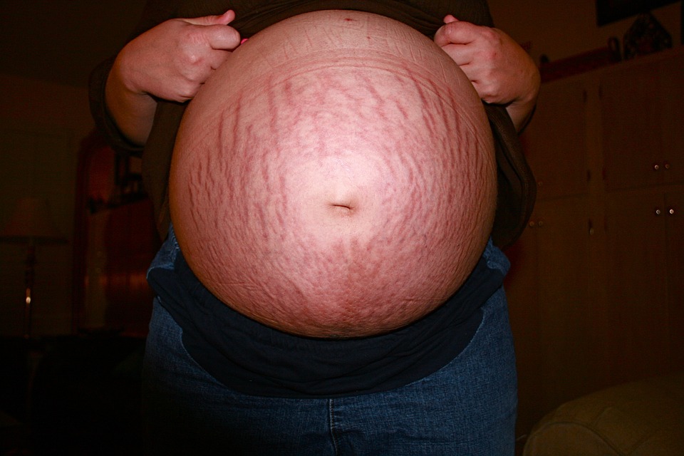man's tummy with a lot of stretched marks